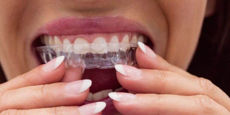 What Are the Different Stages of Clear Aligner Treatment?
